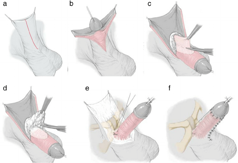 ligamentotomy សម្រាប់ការពង្រីកលិង្គ